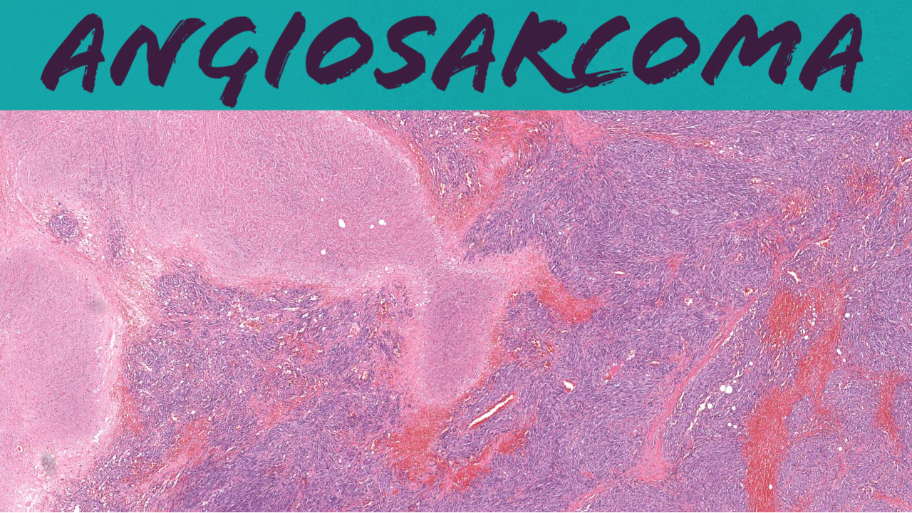 Spindle Cell (NOT Kaposi (Oregon Case 7) video KiKo XP